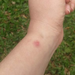 денге лихорадка симптомы у взрослых