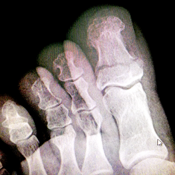 Ногтевая фаланга стопы. Перелом фаланги пальца на ноге рентген. Краевой перелом ногтевой фаланги. Перелом большого пальца на ноге рентген фаланга. Перелом мизинца рентген.