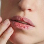 10 причин почему сохнут губы, и чем лечить обветренные губы